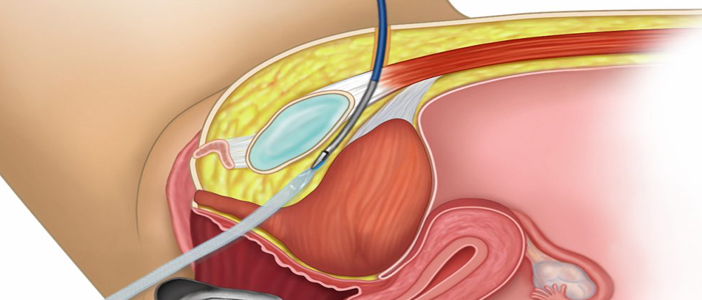 Workshop on Hysteroscopy